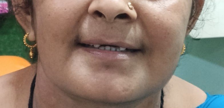 Before dental implant treatment at Bhati Dental Clinic     